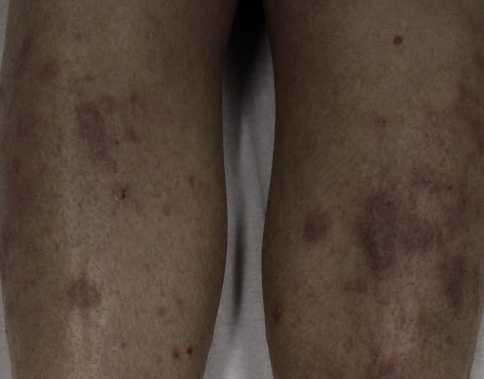 Lichen Planus
