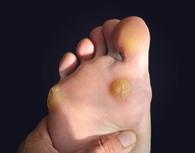 Plantar Corns