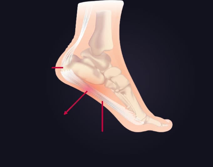 Plantar Fasciitis