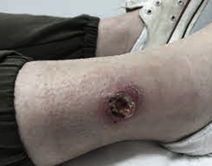 Non-Healing Ulcers treatment placeholder