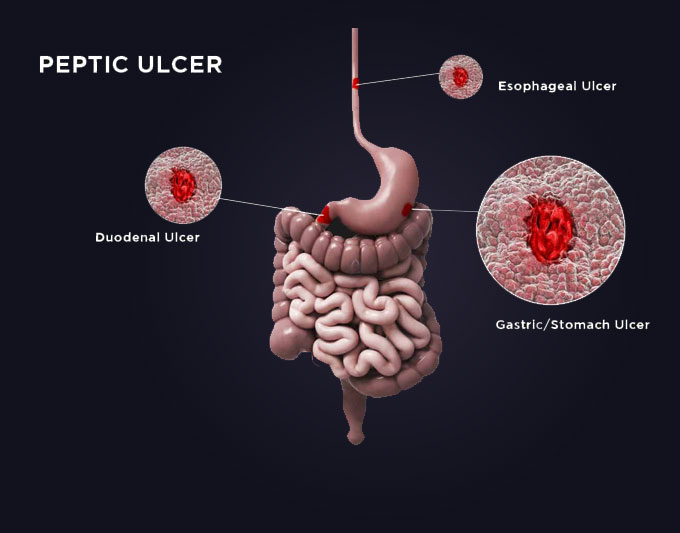Peptic Ulcer treatment placeholder