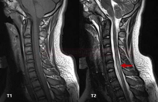 Transverse Myelitis treatment placeholder